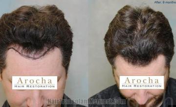 Top view before and after hair restoration results