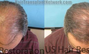 Top view - Before and after surgical hair replacement