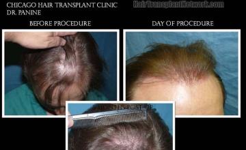 Top view - Before and after surgical hair replacement