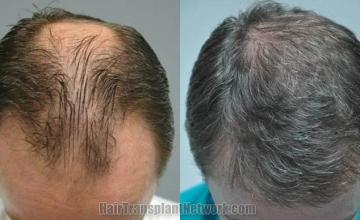 Top view before and after hair restoration results