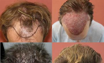 Hair transplantation surgery before and after pictures