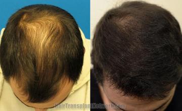 Top view before and after hair restoration results