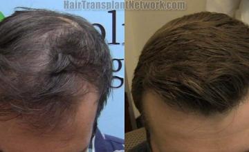 Hair restoration procedure before and after results