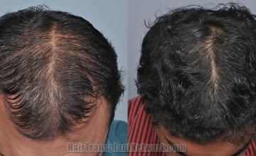 Before and after hair transplant procedure images