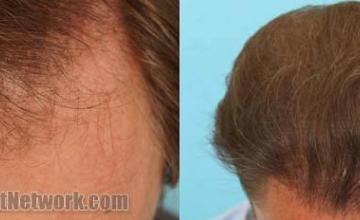 Hair transplantation surgery before and after pictures