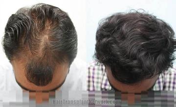 Top view - Before and after surgical hair replacement