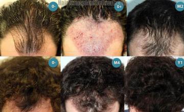 Hair transplantation surgery before and after photos