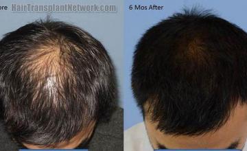 Hair restoration procedure before and after results