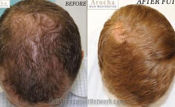 Top view before and after hair restoration results