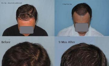 Hair transplantation surgery before and after photos