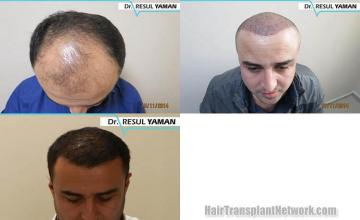 Hair restoration procedure before and after results
