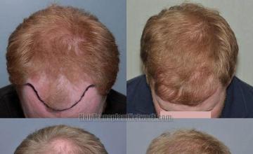 Hair transplantation surgery before and after photos