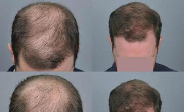 Hair transplantation surgery before and after photos