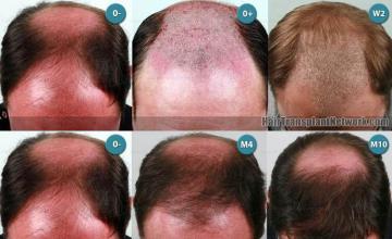 Hair transplantation surgery before and after photos
