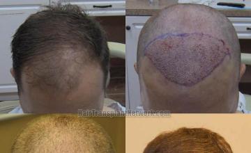 Hair transplantation surgery before and after pictures