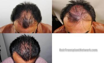 Top view before and after hair restoration results