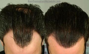 Hair restoration procedure before and after photo results