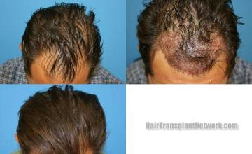 Before and after hair transplant procedure images