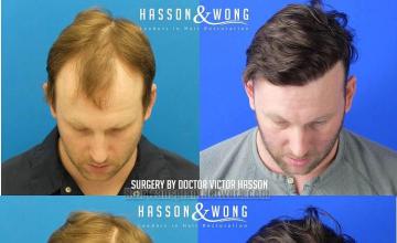 Hair transplantation surgery before and after images