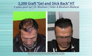 Top view - Before and after hair restoration procedure