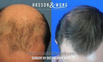 Hair transplantation surgery before and after images