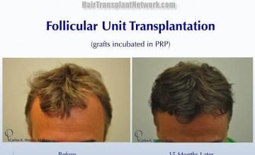 Top view - Before and after surgical hair replacement