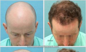 Top view before and after hair restoration results