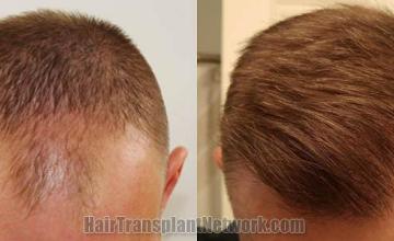 Hair transplantation surgery before and after images