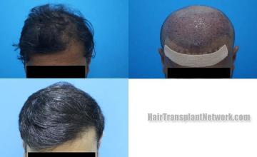 Before and after hair restoration procedure images