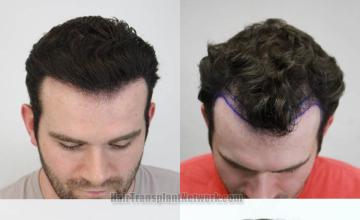 Before and after hair restoration procedure images