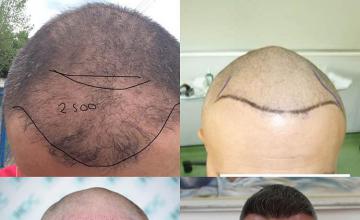 Hair transplantation surgery before and after images