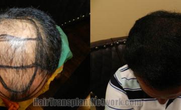 Before and after hair restoration procedure images