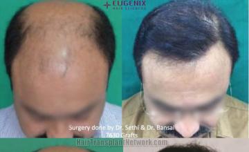 Hair transplantation surgery before and after images