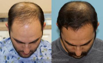 Hair transplantation surgery before and after images