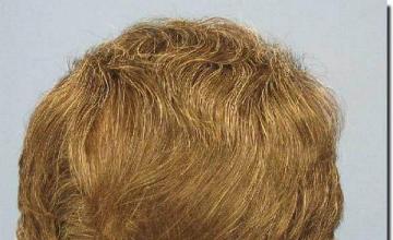 Hair restoration procedure results