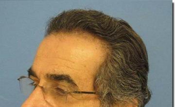 Hair restoration procedure results