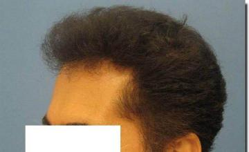 Hair restoration procedure results