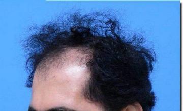 Hair restoration procedure results