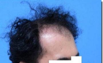 Hair restoration procedure results