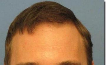 Hair restoration procedure results