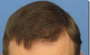 Hair restoration procedure results