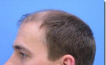 Hair restoration procedure results