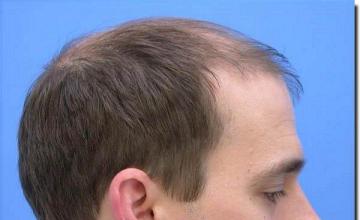 Hair restoration procedure results