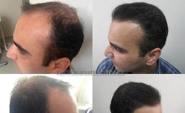 Hair restoration procedure before and after pictures