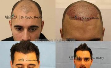 Hair restoration procedure before and after results