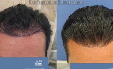 Hair restoration procedure before and after results