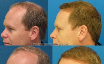 Hair transplantation surgery before and after pictures