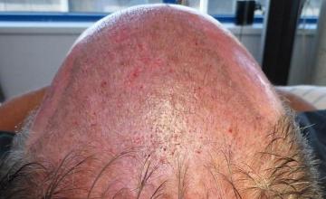 Hair transplant surgery before and after photos