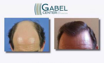 Before and after hair transplant procedure images