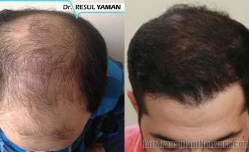 Top view before and after hair restoration results